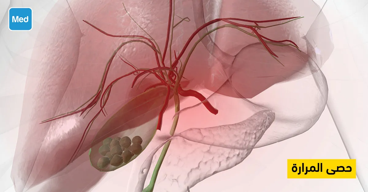 حصى المرارة